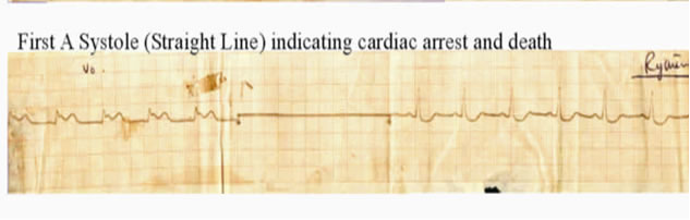 Cardiac Tracing 