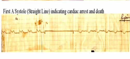 Cardiac Trace 